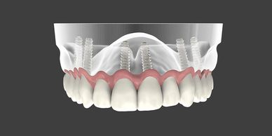 sioux-falls-dental-implant-center-same-day-teeth-kevin-haiar