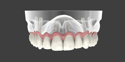 sioux-falls-sd-all-on-4-dental-implants