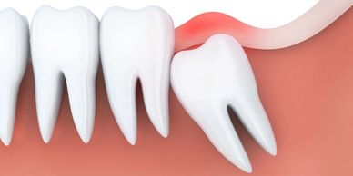 sioux-falls-dental-implant-center-kevin-haiar-wisdom-teeth-3rd-molars