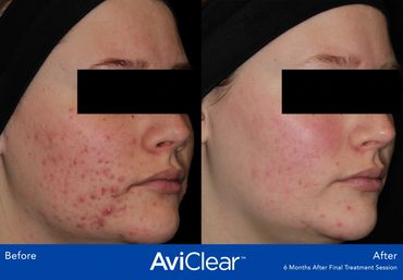 Examples of AviClear results