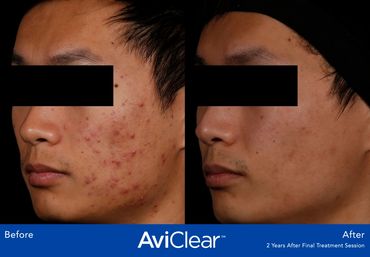 Examples of AviClear results