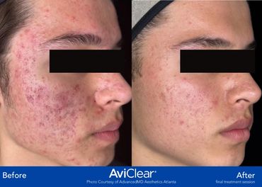 Examples of AviClear results