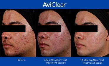 Examples of AviClear results
