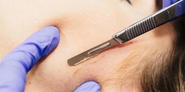 dermaplaining scalpel during treatment