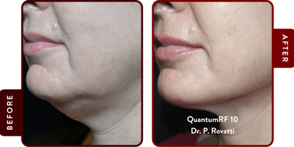 Quantum-RF is done in one session. Minimum down time.
Clients are raving about the remarkable resul