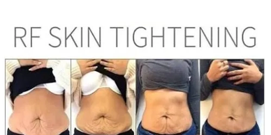 This groundbreaking treatment enables you to reshape your body without surgery, downtime, and delive