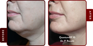 Before and after images showing improved jawline and reduced chin wrinkles.