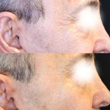Microneedling