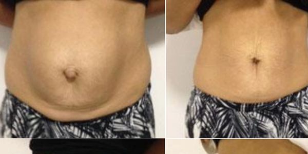A lady showing her belly. The first is bloating and separation before the tupler technique and after