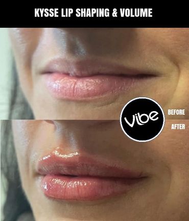 LIP FILLER, KYSEE, RESTYLANE, JUVEDERM, BOTOX, GOLDEN, LAKEWOOD, MEDISPA, ESHTETICIAN, MICRONEEDLING