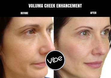 CHEEK FILLER, FACELIFT, SAGGING SKIN, MEDISPA, GOLDEN, LAKEWOOD, HYDRAFACIAL, BOTOX, MICRONEEDLING