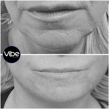 facials, injectables, laser treatments, botox for wrinkles, medical estheticss, lakewood, golden