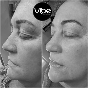 facials, injectables, laser treatments, botox for wrinkles, medical estheticss, lakewood, golden