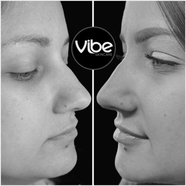 lip filler, injectables, laser treatments, botox for wrinkles, medical estheticss, lakewood, golden