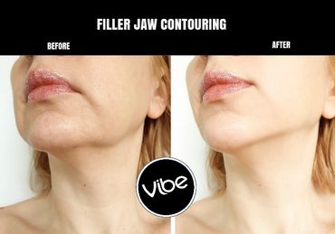 jaw contouring, vibe medispa, golden, lakewood, botox, microneedling, esthetician, plastic surgery