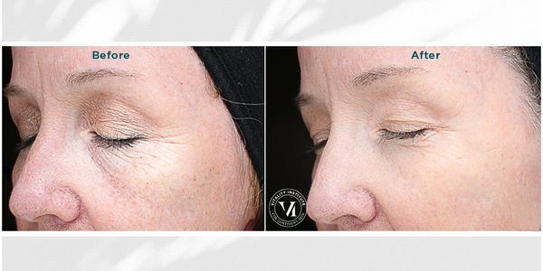 before and after pictures of a woman who had VIPeel treatment