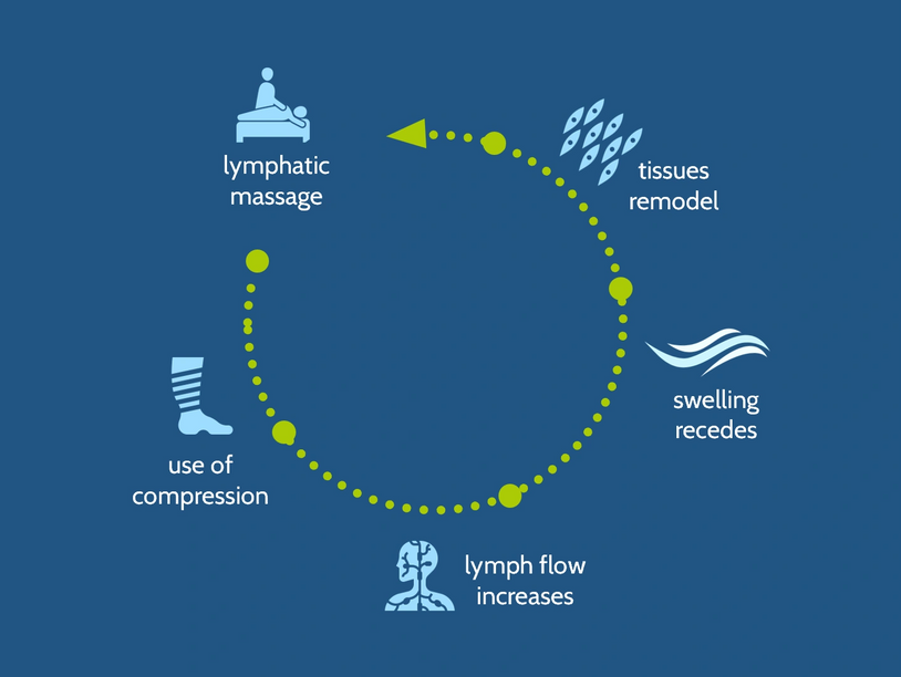 Combined decongestive therapy at the MLD Clinic to reduce swelling from lipedema and lymphedema.