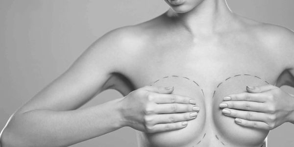 Black and white image of a woman covering her breasts with surgical markings around them.