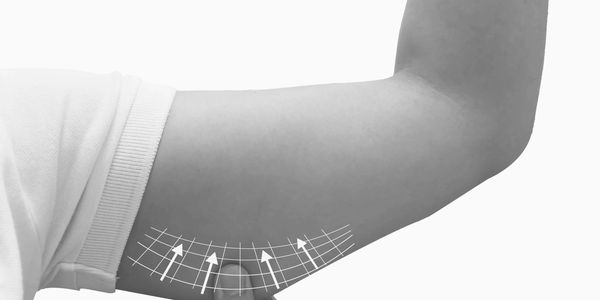 Person pinching upper arm skin with arrows indicating arm liposuction