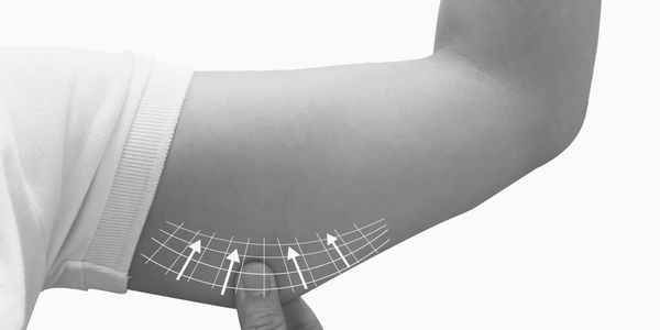 Person pinching upper arm skin with arrows indicating skin lift.