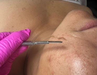 Close-up of a person receiving a Dermaplane facial.