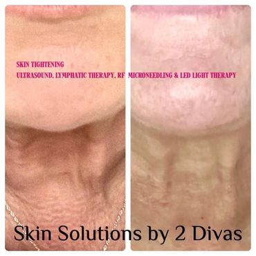 Before and after skin tightening treatment results on neck area.