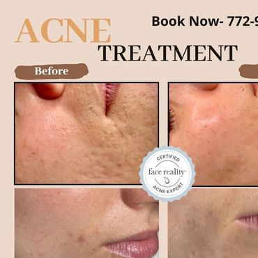 Before and after photos showing improved acne treatment results.