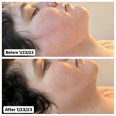 Before/after photo of a post-op MLD treatment showing decreased swelling in client's face and neck.