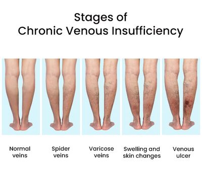 Photo showing the stages of chronic venous insufficiency.