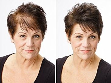 Hairpiece solve thinning hair problem.