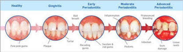 periodontal disease gingivitis bone loss periodontal disease gingivitis scaling and root planing