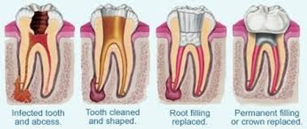 root canal dentist endodontist root canal dentist best dentist root canal root canal root canal best