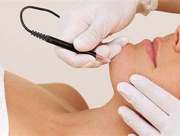 electrolysis hair removal on chin