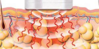 Colour drawing of how ultrasound vibrations travel through the skin to the fat cells