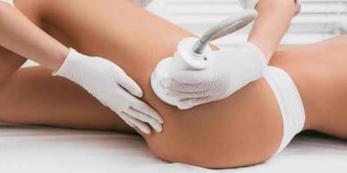 Practitioner using a fat cavitation machine on a woman’s thighs