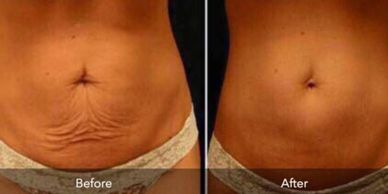 Awesome fat melting results from fat cavitation treatment at Xora Health
