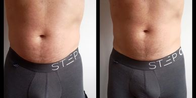 Fat Melting | Cavitation fat loss results after just one session