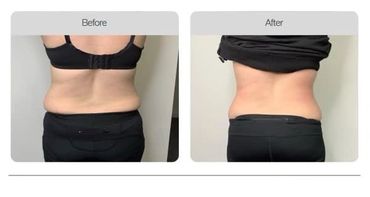 Fat Reduction Before and After