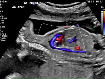 Ultrasound image showing fetal aortic arch with blood flow at 20 weeks 3 days gestation.