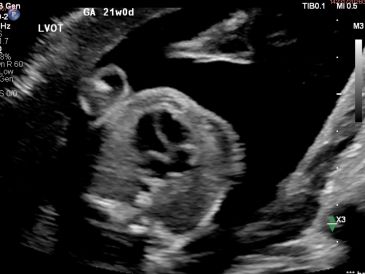 Ultrasound of a 21-week-old fetal heart showing LVOT.