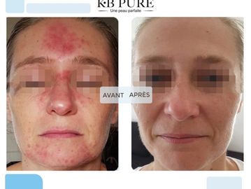 Kb pure skin treatment 
Acne pigmentation aging redness sensitivity back acne butt acne roseacea 