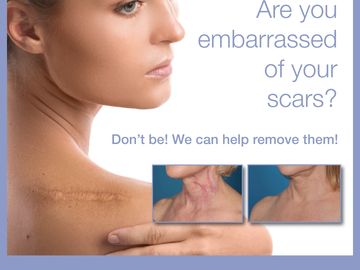 #scarremoval #skinresurfacing #fractional #peels #laserclinic #theskinlaserclinic #evropalaserspa