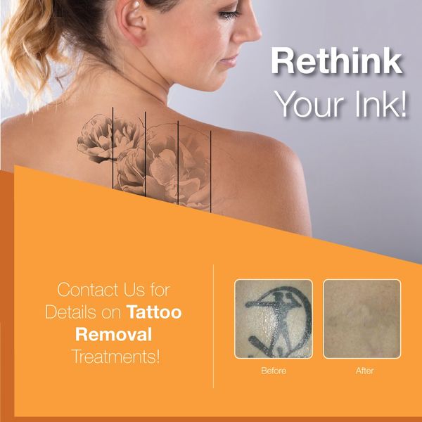 #tattooremoval #laserclinic #inkregrets #tattoos #byebyetattoo #gtalaserclinic #bodytunedby #ink