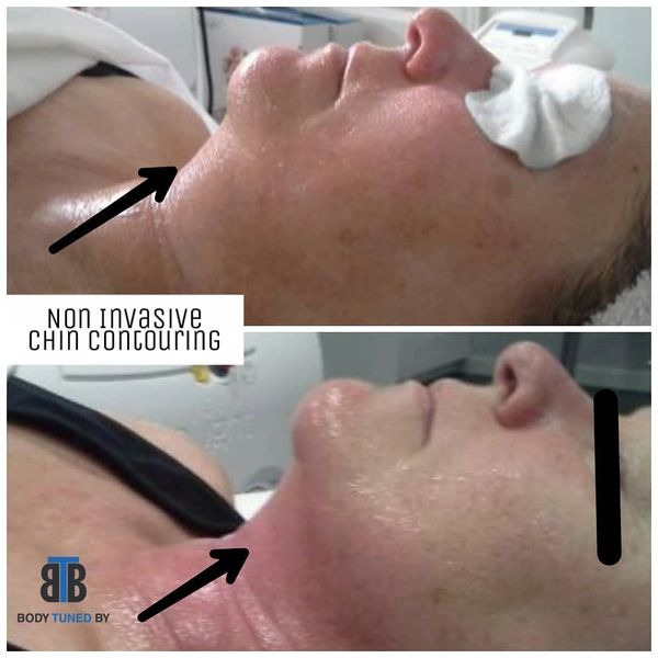 #doublechin #nonsurgryfacelift #facelift #fatremoval #chinfat #skintightening #rf #infrared #lifted