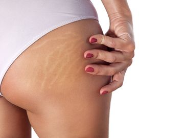 #cellulite #stretchmarks #dermaroller #hasegawaclinic #luminesselaser #advancedlaserskinclinic #skin