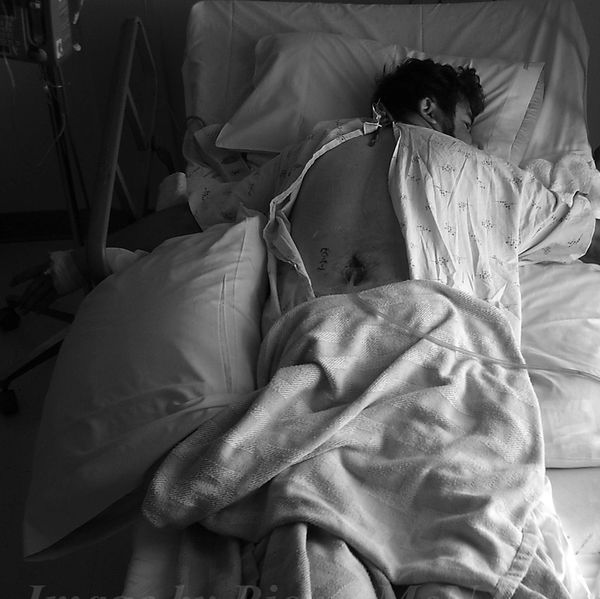 Rich Gill, Back Surgery, Pain Blocker Failure,