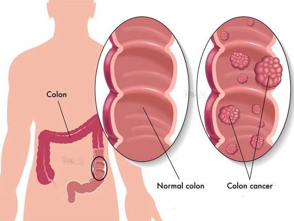 Healthy & Unhealthy Colon