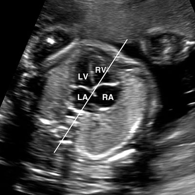 3D 4D Fetal echo procedure at Dr. Chawla's