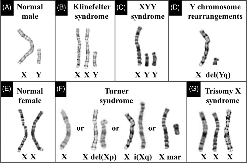 Image of medical diagnoses for sex chromosome anomalies, eg Klinefelter, XYY and Turner Syndromes