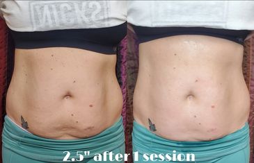 Lipo Laser Cavitation and Radio Frequency liquify and collapse the contetns of the fat cells to be e